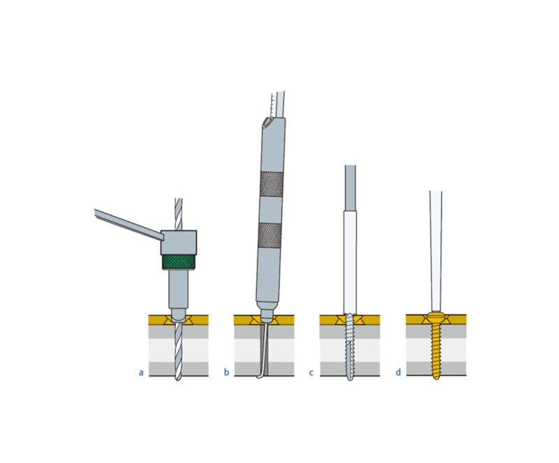 Load And Neutral Drill Guides For LC-DCP And DCP