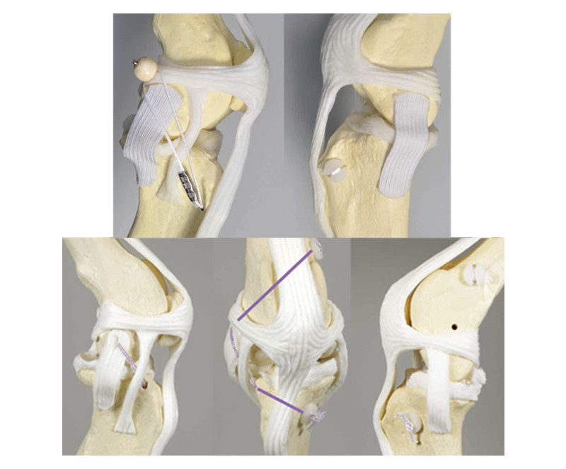 Lateral Sutures