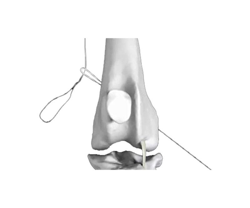 Ligment Sutures Passer